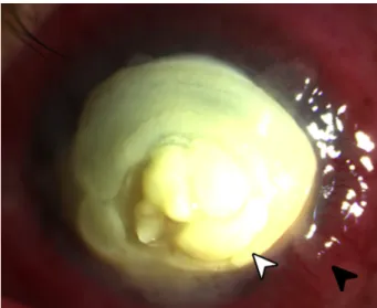 Figure 1: Slit lamp photograph of eye showing a large yellowish plaque (white arrowhead) occupying almost the entire cornea