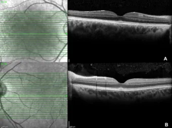 Figure 1: OCT demonstrates hyperreflectivity and irregularity of the ellipsoid zone at the fovea; A) OD, B) OS
