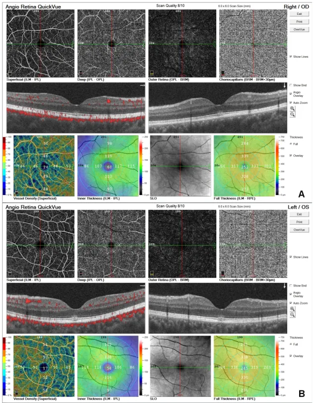 Figure 3: OCTA was normal; A) OD, B) OS