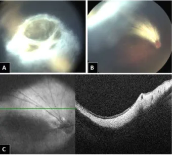 Figure 1: A) &amp; B) Fundus photos showing a yellowish white shiny area superior to the disc extending till the superior ora and forming a membranous fold behind the lens in this area,