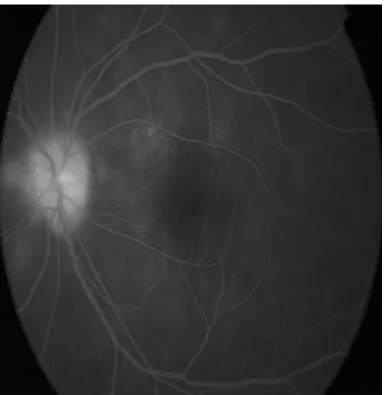 Figure 2: Fundus flourescein angiography of left eye depicting disc leakage