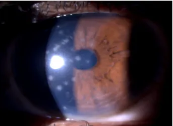 Figure 4: Slit-lamp photo showing circular subepithelial infiltrates in the right eye
