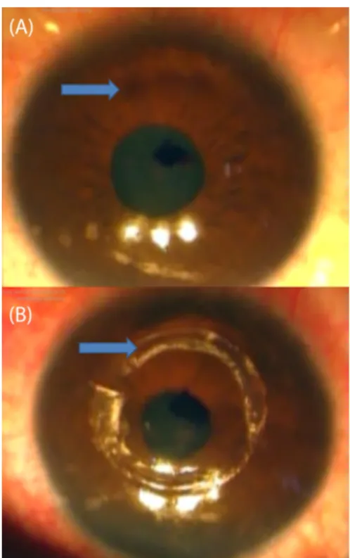 Figure 1: (A) Superior corneal protrusion without associated scarring or vascularization; (B) Two implanted Kerarings Specular examination (Topcon SP-2000P, Topcon, Tokyo, Japan) of the left eye revealed normal corneal  endotheli-um.