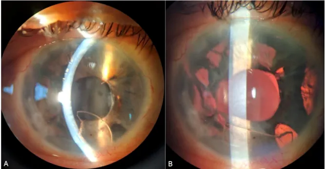 Figure 1: A) Anterior segment photograph of large optic fragment (arrow) in the anterior chamber with mild corneal edema.