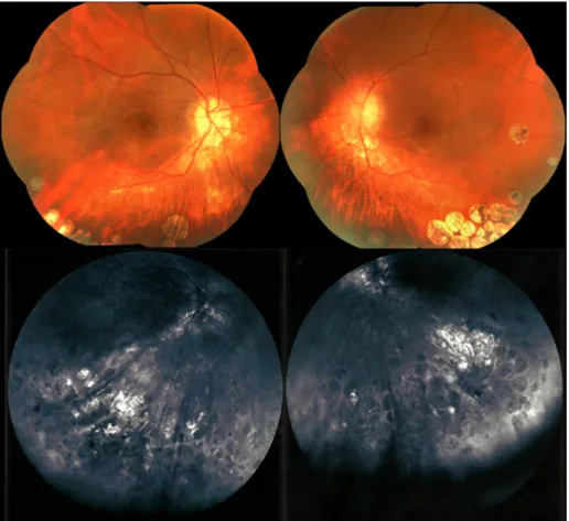 Figure 1: Fundus photographs showing patches of chorioretinal atrophy in the inferior retina of both eyes