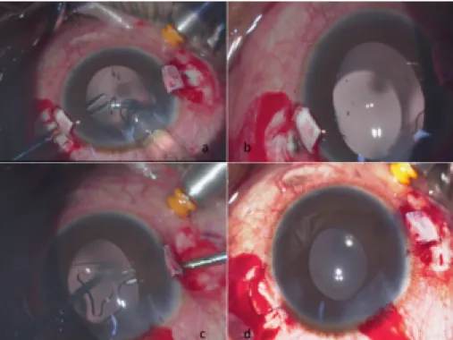 Figure 2: Showing grasping of the T-junction with the PraNIv T-flex forceps (A), exteriorized leading haptic under the scleral flap (B), grasping of the lagging haptic by the handshake technique (C) and the exteriorized lagging haptic (D)
