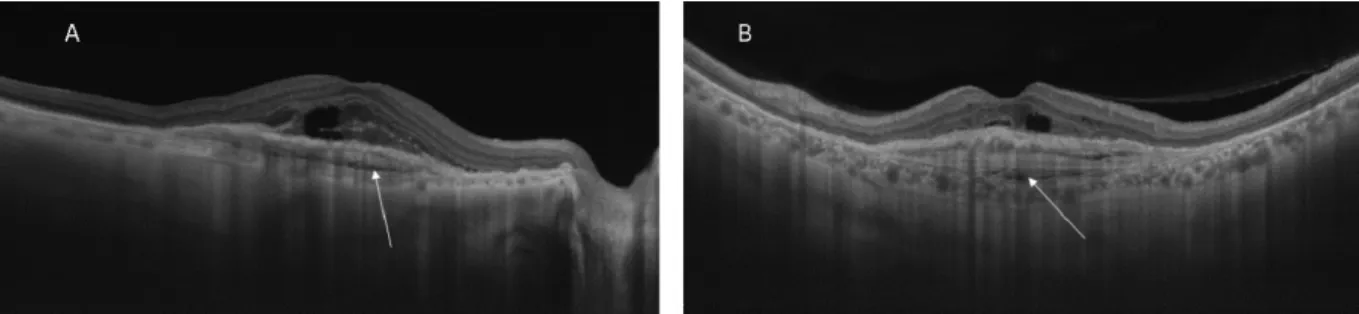 Figure 4: The radial scans of the SSOCT of the right eye (A) and the left eye (B) show the spindle-shaped horizontal laminae in the area of the PED that are characteristic of a multilayered PED along with the hyporeflective choroidal cleft (arrows).