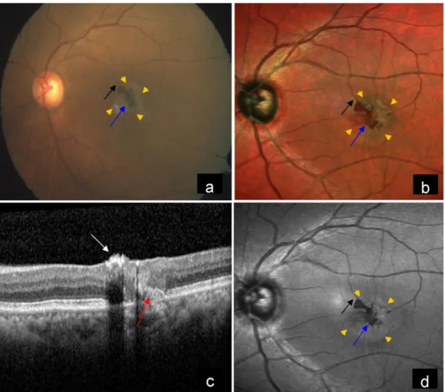 Figure 2: a) CFP of the left eye showed grayish discoloration at the macular area (yellow arrow heads) due to subretinal fibrosis, dark pigment clumps (blue arrow) and right-angled venule (black arrow)