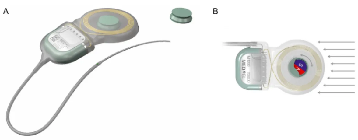 Figure 1: The MED-EL Mi1200 SYNCHRONY Cochlear Implant (MED-EL, Innsbruck, Austria) is compatible with MRI at a magnetic-field strength of up to 3 T and with the possibility of removing the internal magnet (1A)