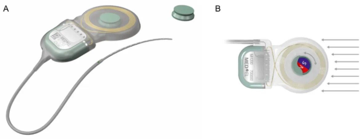 Abbildung 1: Das MED-EL Mi1200 SYNCHRONY Cochlea-Implantat (MED-EL, Innsbruck, Österreich) ist bei einer Magnetfeldstärke von bis zu 3 T und mit der Möglichkeit, den Innenmagneten zu entfernen, MRT-kompatibel (1A)