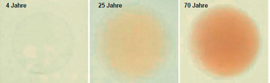 Abb. 13 : Zunehmende Pigmentierung der Linse während des Alterungsprozesses; vgl. http://acrysof-restor.de/