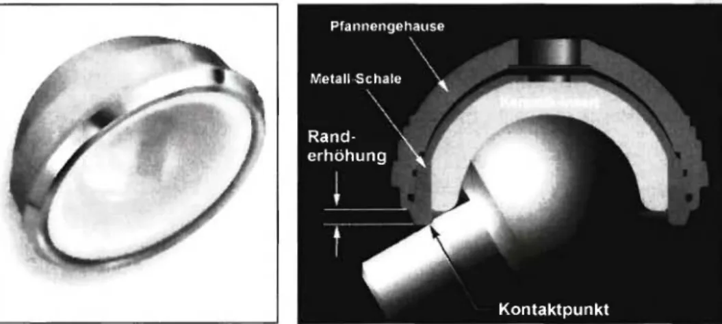 Abb. 7: Beispiel für ein Pfannensystem mit randerhöhtem Pfanneneinsatz (hemisphärisches Keramik-Insert in  überstehende Metallschale eingepasst)