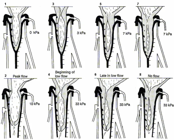 Figure 3: Tracings of pairs of radiographs at four stages of milking. Marks on the left side of the  teat were originally 10 mm apart just before the teat entered the teatcup at the start of milking