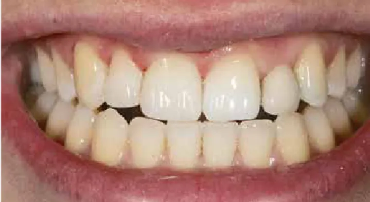 Abb. 11: En face-Aufnahme der gesamten Oberkieferfront. Abb. 12: Detailaufnahme der Zähne 13-11