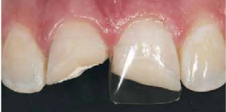 Abb. 32: Frakturflächen an den Zähnen 11 und 21 nach provisorischer  Abdeckung der Dentinflächen mit Zement und Flow-Komposit im Notdienst.