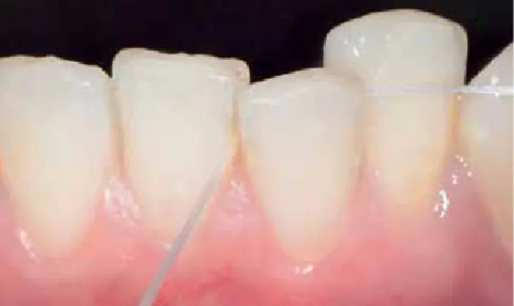 Abb. 1: Da Zahnseide eine geringe Kontaktoberfläche mit geringer Reinigungs- Reinigungs-wirkung aufweist, sollte sie nur Verwendung finden, wenn eine sehr enge oder  verschachtelte Morphologie der Zahnreihe besteht, welche die Verwendung  selbst kleinster 