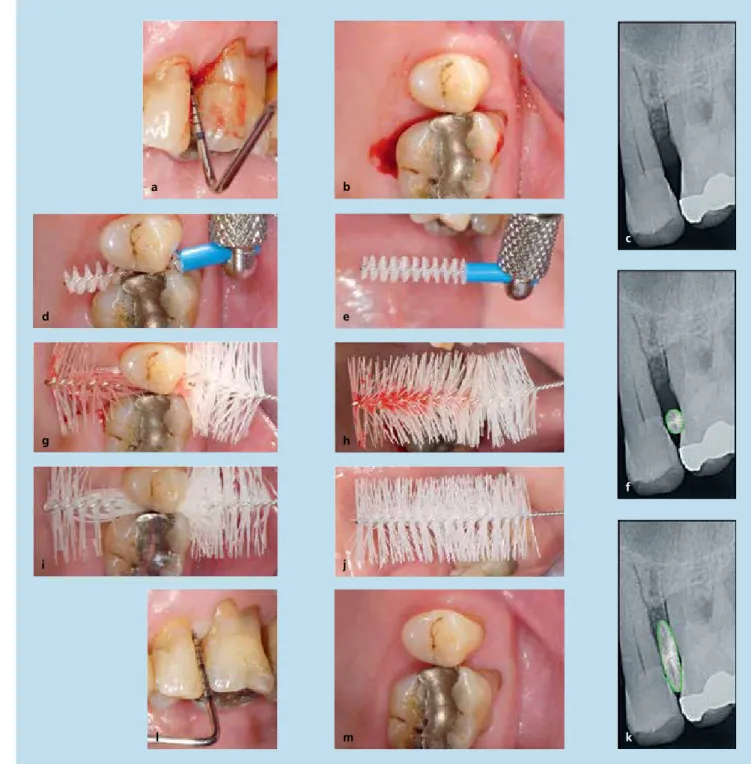 Abb. 5: Situation bei einem 74-jährigen Patienten mit Gingivitis und Parodontitis unterschiedlichen Ausmaßes