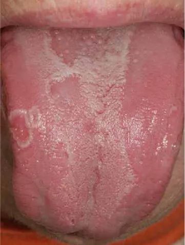 Abb. 5: Rote Maculae als Zeichen einer erythematösen Candidiasis nach  mehrwöchiger Einnahme von Antiinfektiva bei einem 36-jährigen männlichen  Patienten.