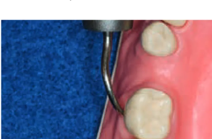 Abb. 3: Die Arbeitsspitzen sind richtig angelegt, wenn die Kurvatur des  Instrumentes zum zu bearbeitenden Zahn zeigt.