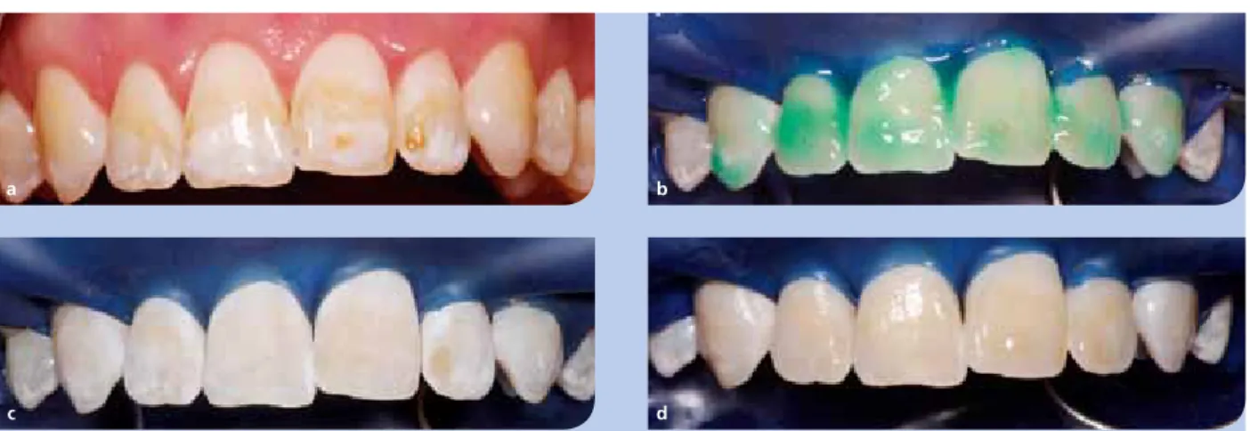 Abb. 2a:  Weißliche und bräunliche Schmelzveränderungen (Fluorose) sowie ein Schmelzdefekt mesial an Zahn 21.