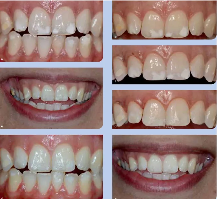 Abb. 3 a u. b:  Weißliche Veränderungen der Zähne (MIH); vor allem betroffen: mittlere Schneidezähne im OK, aber auch die Zähne 12 und 13   weisen hypomineralisierte Bereiche auf