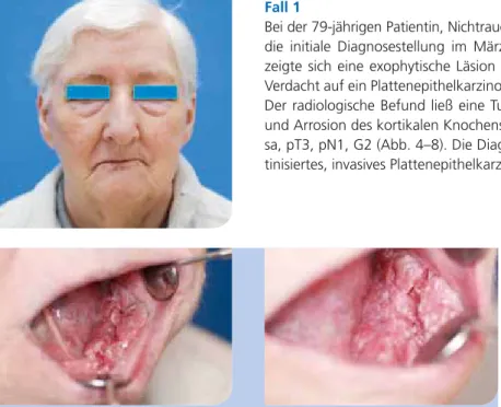 Abb. 2 u. 3: Intraoraler klinischer Status. Abb. 4: PAN, UK, Region of Interest (ROI)