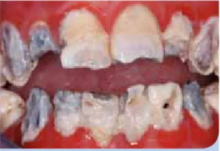 Abb. 2: Der dunkle Dentinschatten (ICDAS  Code 4) deutet sicher auf eine  unterminie-rende Dentinkaries hin