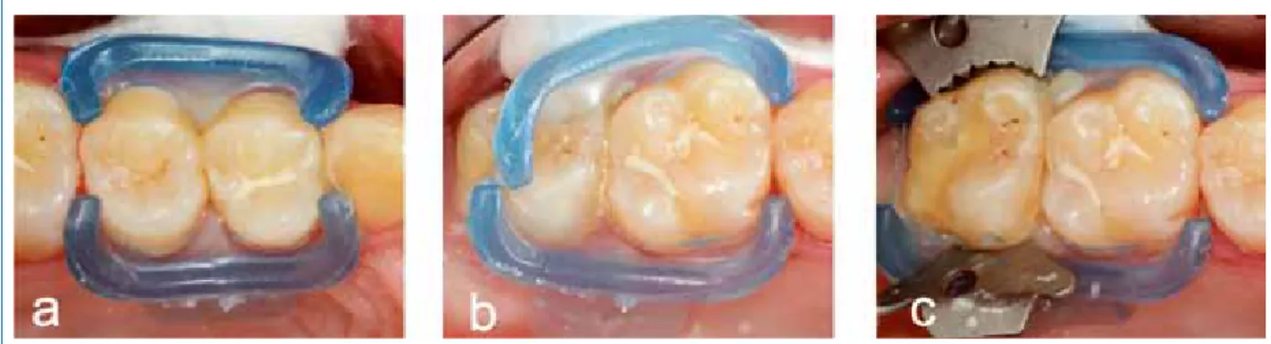 Abb. 4: Übersicht der Progressionsraten der bisher am längsten  laufende Studie zur approximalen Kariesinfiltration an permanenten  Zähnen [5]