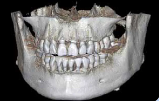 Abb. 4: Taschentiefenmessung im Rahmen der Anfangsdiagnostik. Abb. 5: Mithilfe von DVT-Daten ist eine dreidimensionale Darstel- Darstel-lung und Vermessung des parodontalen Knochendefizites im  zahn-tragenden Alveolarfortsatz möglich