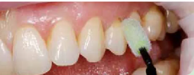 Abb.  2:  Schonende  professionelle  Zahnreinigung  mit  weichem  Kelch und einer bimssteinfreien Prophy-Paste