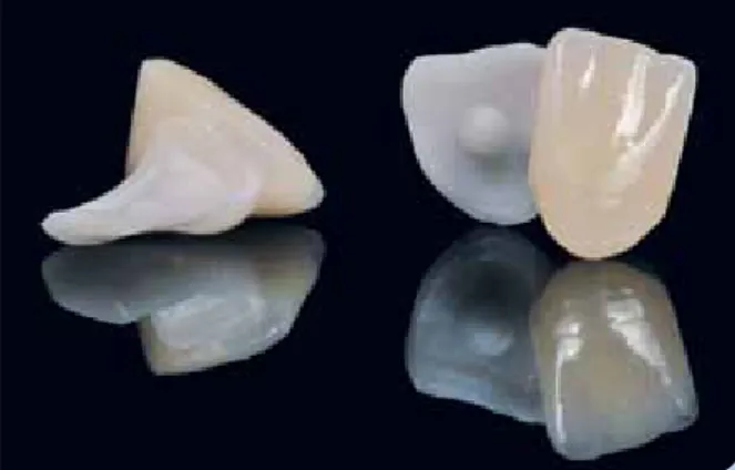Abb.  4:  Ausgangssituation  von  vestibulär,  Aplasie  der  Zähne  31  und 41 nach erfolgter Mesialisierung.