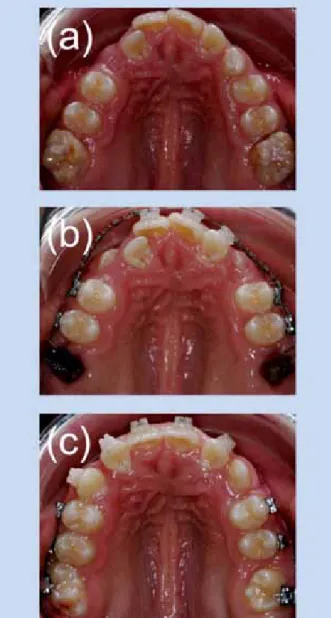 Abb. 4: Restaurative Konzepte für MIH-Molaren. Sowohl Kompo- Kompo-sitrestaurationen (links im Bild) als auch präformierte Stahlkronen  (rechts im Bild) zeigen in klinischen Studien akzeptable  Überlebens-zeiten.