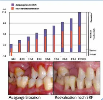 Abbildung 1 zeigt nicht nur, wie sich bei einwurzligen Zähnen  unterschiedlich tiefe Ausgangstaschen durch Scaling &amp; Root  Planing (SRP) verringern, sondern auch, wie sich die  Reduk-tion auf Rezession und klinischen Attachmentgewinn  ver-teilt