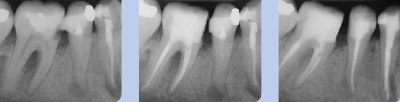 Abb. 3: Ausgangssituation Zähne 44-46. Abb. 4: WF an Zahn 46 mittels lateraler  Kondensationstechnik.