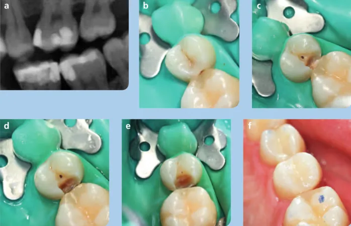 Abb. 3: Selektive Kariesentfernung bis zum weichen Dentin. (a) Zahn 25 ist vital und asymptomatisch, zeigt jedoch distal eine Dentinläsion  bis ins innere Dentindrittel