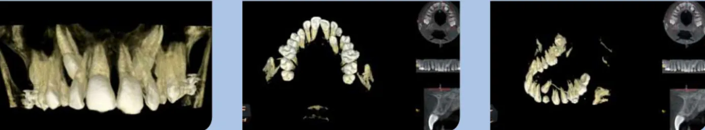 Abb. 7 a–j: Bilder eines 12-jährigen Patienten mit einem verlagerten und retinierten Zahn 23