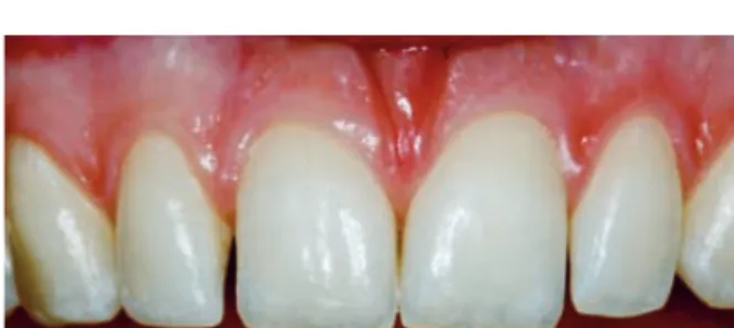 Abb. 10: Detailaufnahme der Zähne 12 und 11. Die Lücke fällt hier  stärker auf als auf der kontralateralen Seite.
