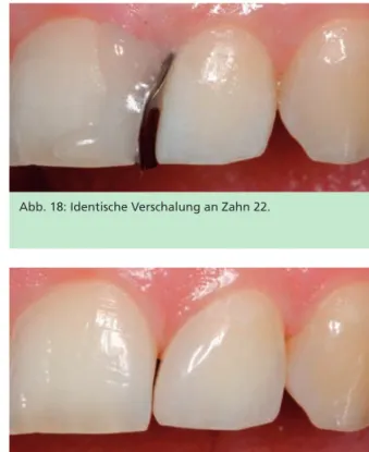 Abb. 17: Mit vertikal inserierter, zurechtgeschnittener Teilmatrize  verschalte Situation an Zahn 12.