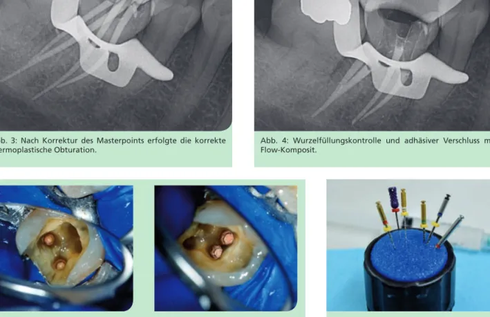 Abb. 5 und 6: Blick durch das Dentalmikroskop auf die mesialen bzw. distalen Kanalein- Kanalein-gänge nach thermoplastischer Wurzelfüllung.