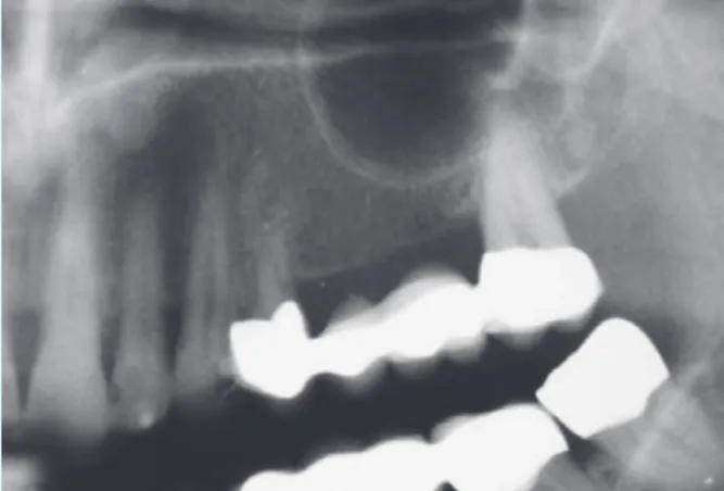 Abb. 1: Röntgenologische Ausgangssituation. Gemessene Knochen- Knochen-höhe von Sinusboden bis zum Kieferkamm: 6 mm.