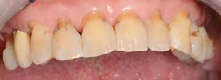 Abb. 5: Multiple erosive und abrasive Defekte der Zahnhälse und Inzisalkanten  bei einem 80-jährigen Patienten.
