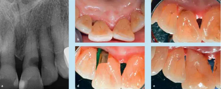 Abb. 1: restaurative Versorgung einer ausgeprägten Wurzelkariesläsion an Zahn 21 bei einer 87-jährigen patientin:
