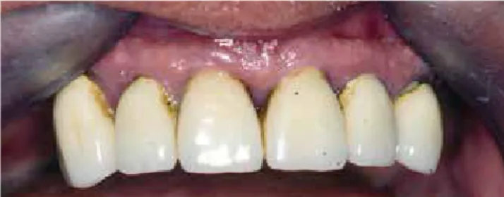 Abb. 4: Zustand nach systematischer parodontitistherapie: vollständige  Rückbildung der Gingivahyperplasie.