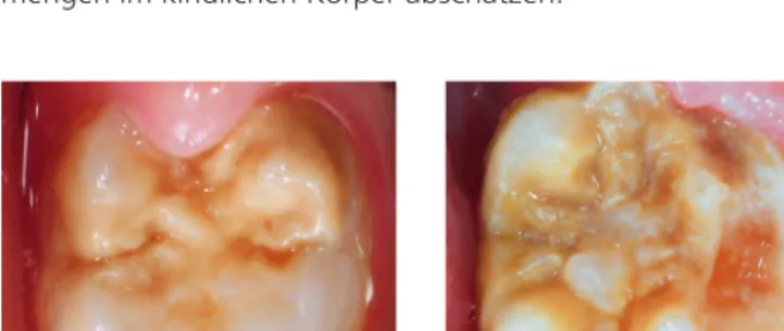 Abb. 1: Blickdiagnose: Molaren-Inzisiven-Hypomineralisation. Gut erkennbar  sind die scharf begrenzten weiß-gelblichen Opazitäten.