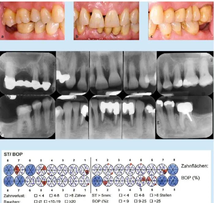 Abb. 3a-e: Chronisch generalisierte (Raucher-)Parodontitis [31] bei einem männlichen Patienten (geb