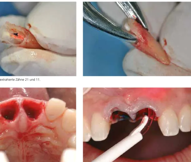 Abb. 7: Extraktionsalveolen mit unversehrten hart- und weichgeweblichen Struk- Struk-turen.