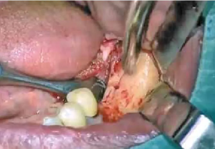 Abb. 10: Während der Insertion des Implantats wurde die Oberfläche mit PRGF  benetzt.