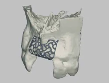 Abb. 2: Das DVT zeigt das bukkale Knochendefizit. Abb. 3: Ein präzises 3D-Planungsmodell, erstellt auf Basis von DVT-Daten.