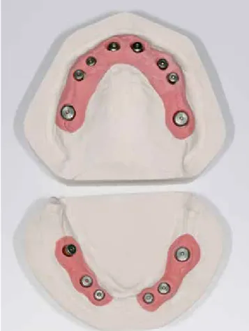 Abb. 17: Konstruktion des Oberkiefer-Langzeitprovisoriums; hier: Cutback des  Dentinkerns.
