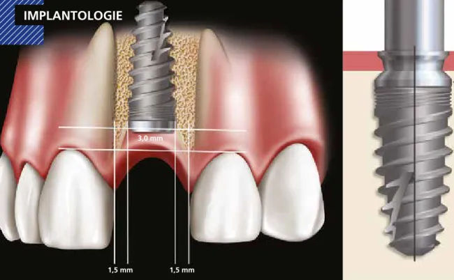 Abb. 1b: Zwischen benachbarten Implantaten sollte ein 3,0 mm- mm-Abstand vorliegen.